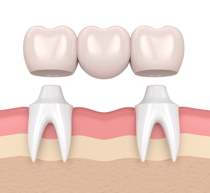 3d render of dental bridge with dental crowns